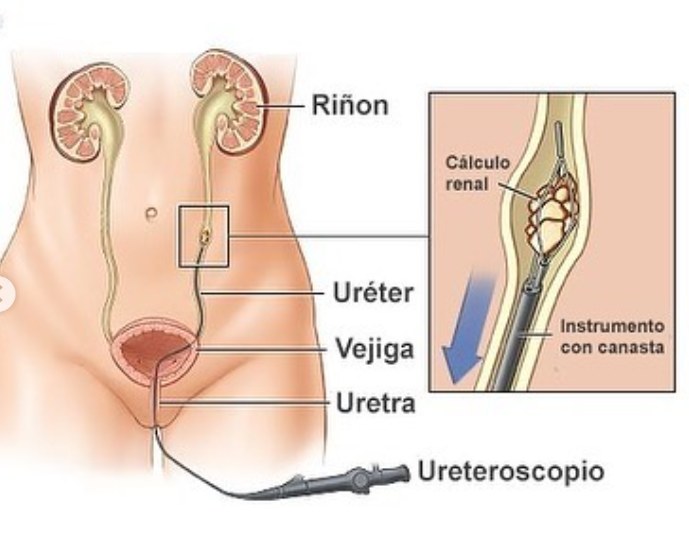 Esquema del sistema urinario y la ureteroscopia
